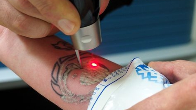 Intense Pulse Light Therapy Tattoo Removal