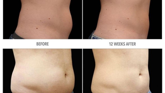 Say Goodbye to Stubborn Fat: Unveiling the Magic of Cool Sculpting and Fat Freezing