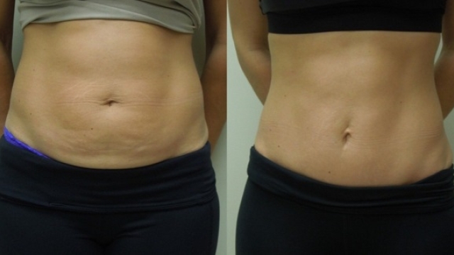 Flat Belly Dreams: The Ultimate Guide to Abdominoplasty