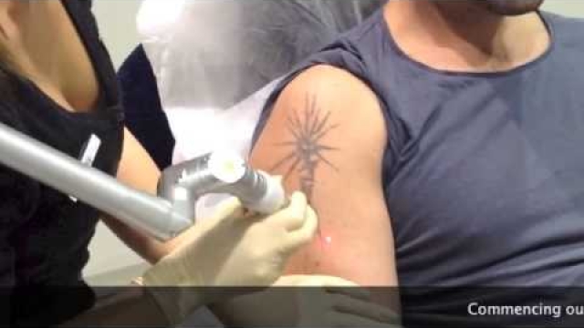 Tattoo Removal Options – Laser Tat Removal Or Perhaps Tattoo Removal Cream