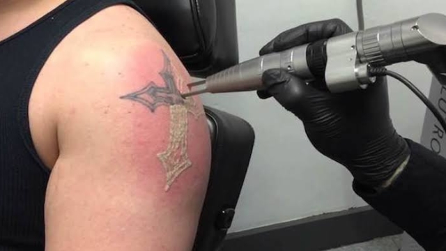 Tca Tattoo Removal – Ideal For Removing Leg Tattoos