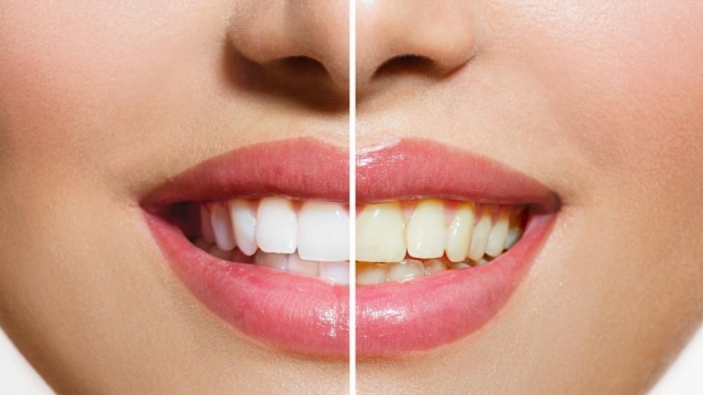 Sparkling Smiles: Unveiling the Secrets of Teeth Whitening