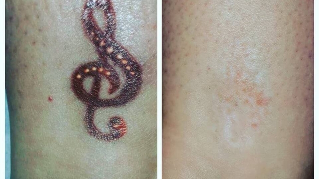 What You Do Not Know About Tattoo Laser Removal!